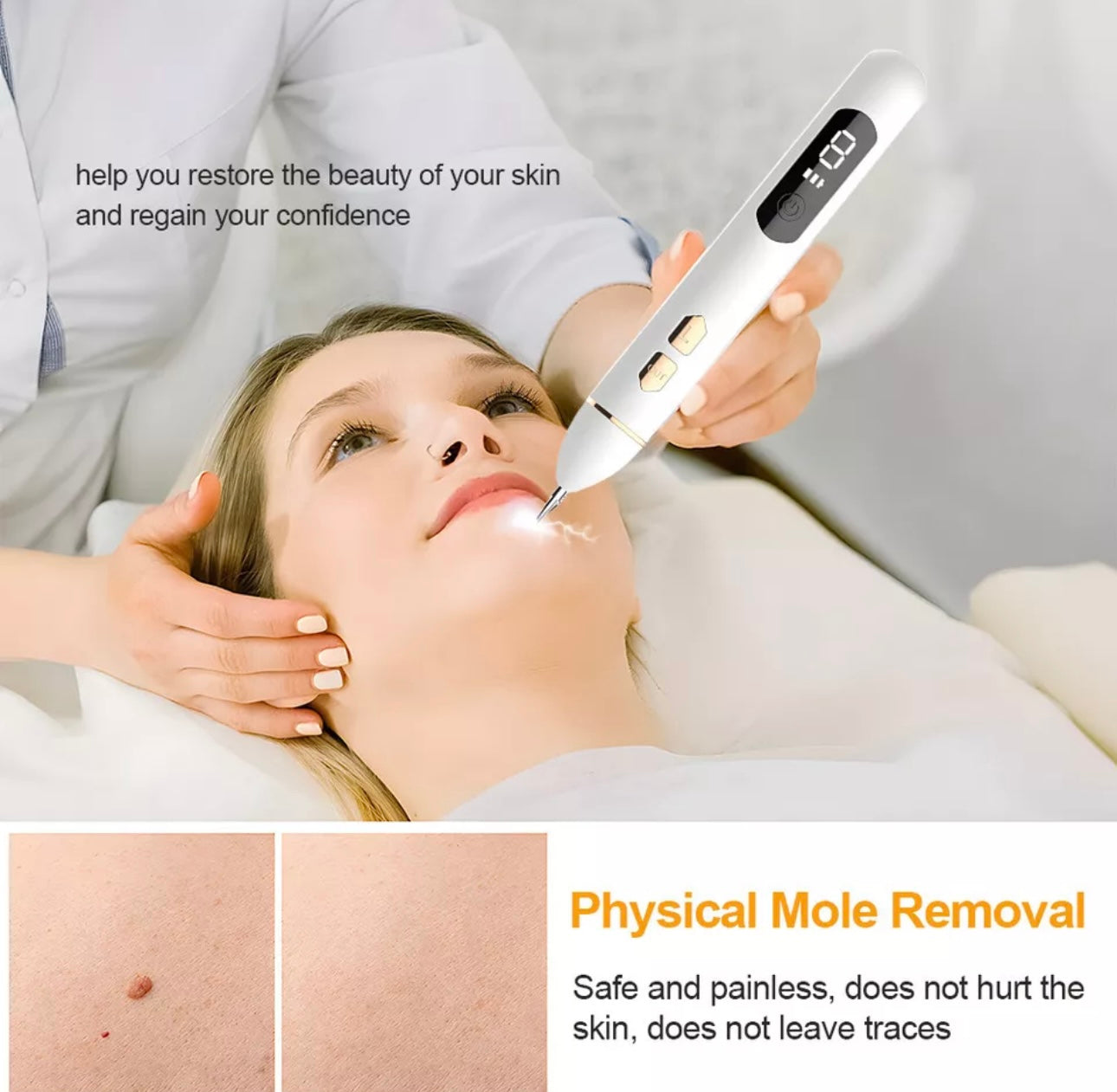 9 level plasma pen for mole removal